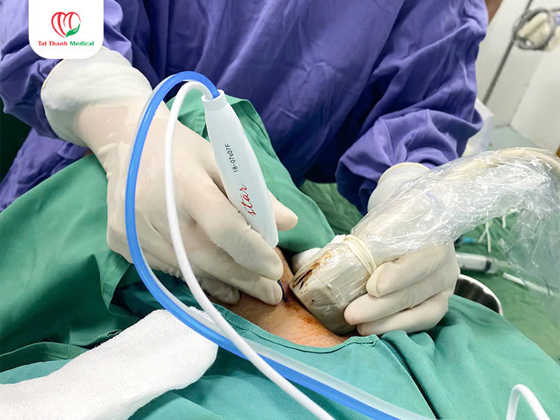 U tuyến giáp: Chẩn đoán và điều trị không phẫu thuật với máy đốt sóng cao tần (RFA)