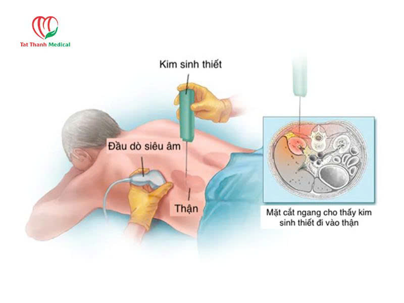 Kim sinh thiết lõi