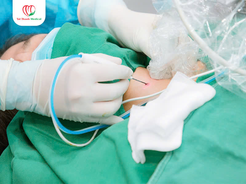 Máy đốt sóng cao tần u tuyến giáp