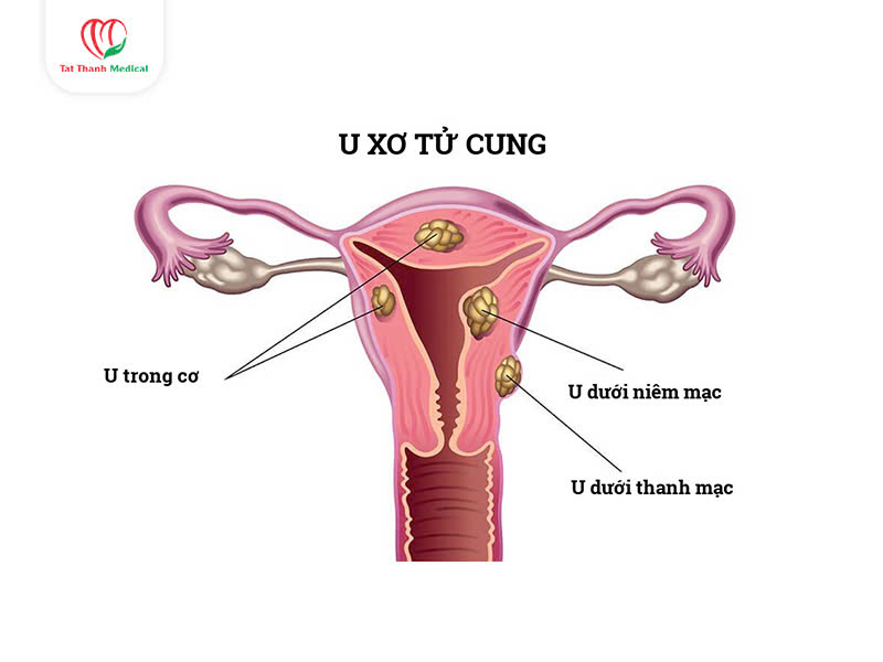 U xơ tử cung