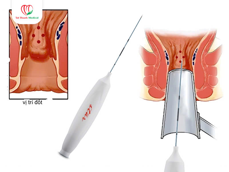 Kim đốt sóng cao tần điều trị trĩ