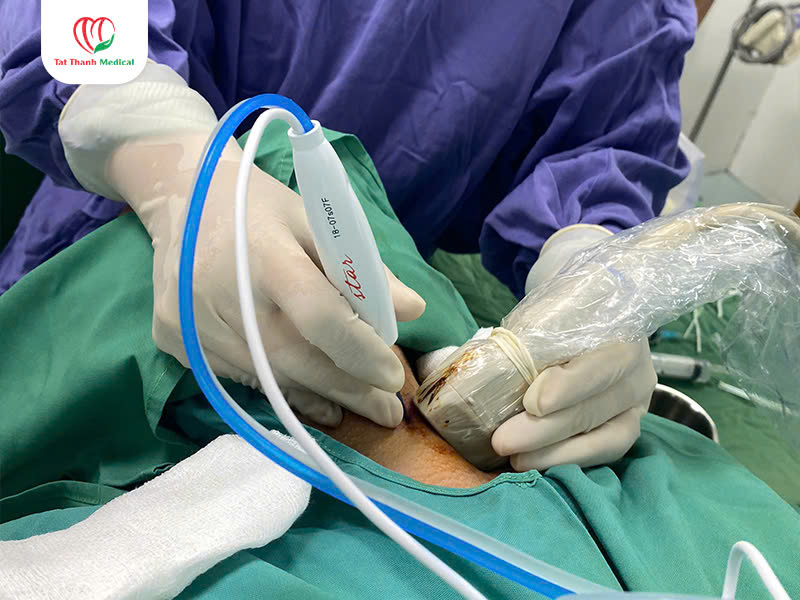 Máy đốt sóng cao tần u tuyến giáp trong phòng mổ