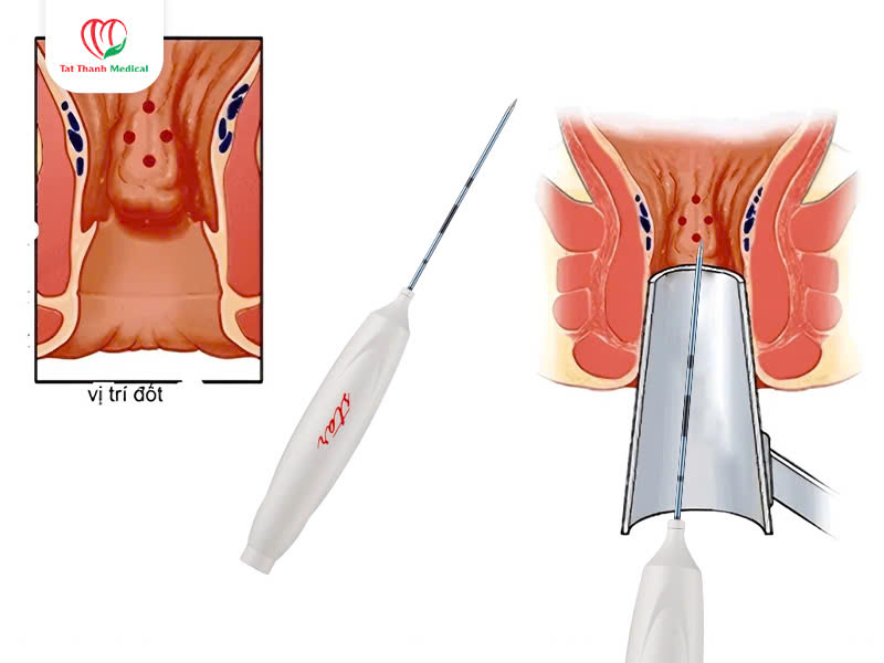 kim điều trị trĩ bằng sóng cao tần 