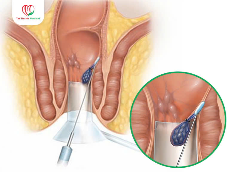 vị trí điều trị trĩ bằng sóng cao tần