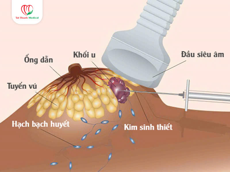 kim sinh thiết lõi
