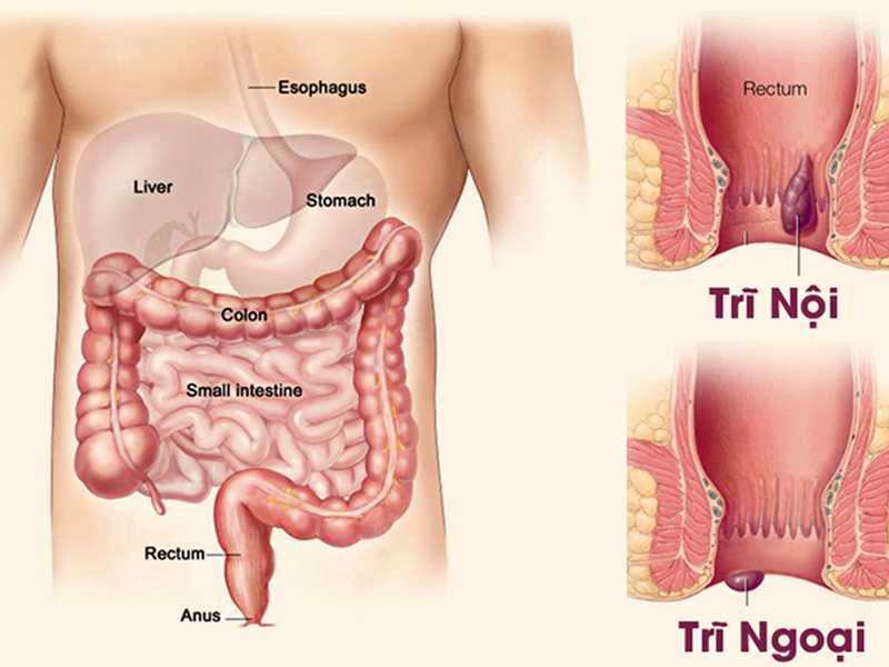 Trĩ gây ảnh hưởng đến sức khỏe và sinh hoạt