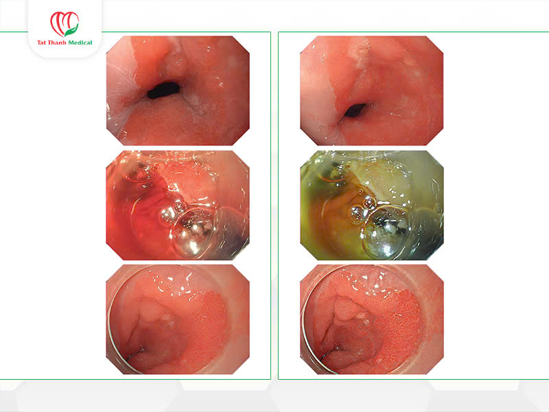 Độ phân giải cao giúp phát hiện tổn thương sớm