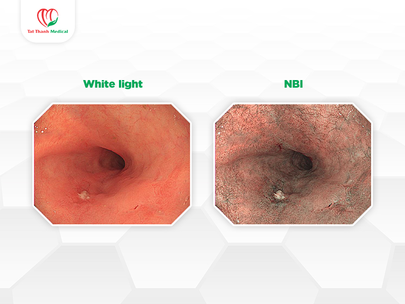Hệ thống nội soi Olympus: Tiêu chuẩn vàng cho phòng nội soi tiêu hóa hiện đại