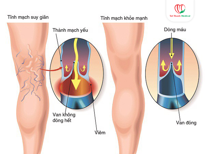 RFA điều trị suy giãn tĩnh mạch chi dưới đang trở thành xu hướng điều trị hiện đại