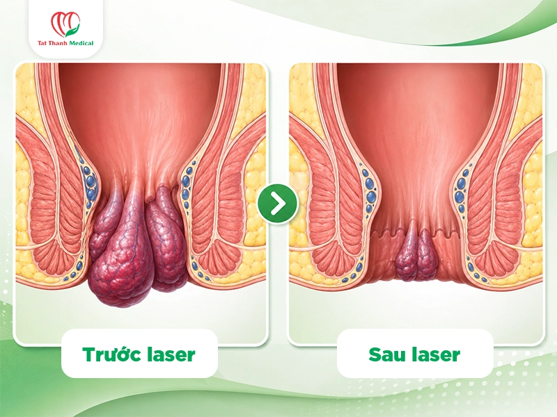 Laser tác động lên búi trĩ ra sao?