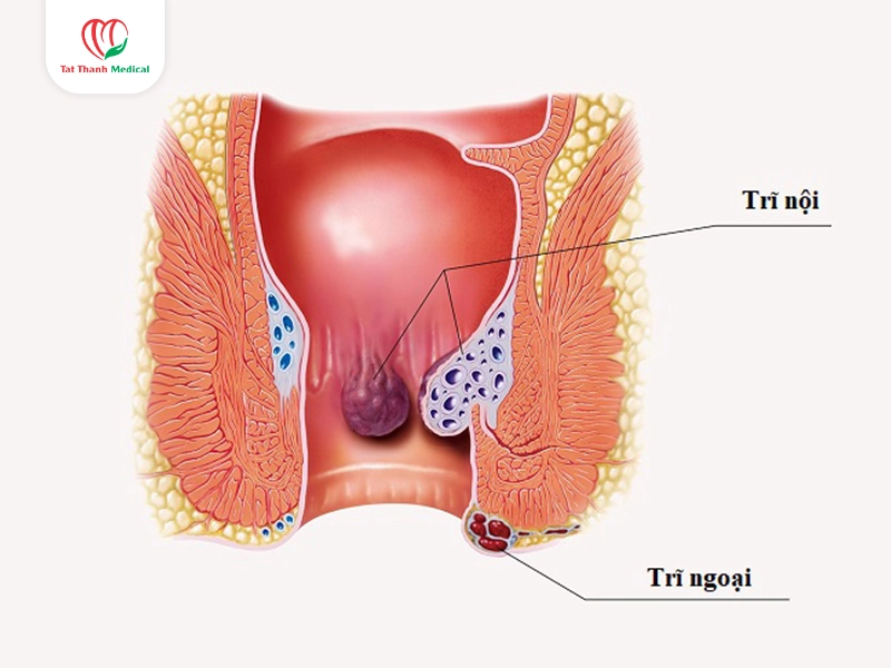 Đối tượng nào có thể phù hợp với laser điều trị trĩ?