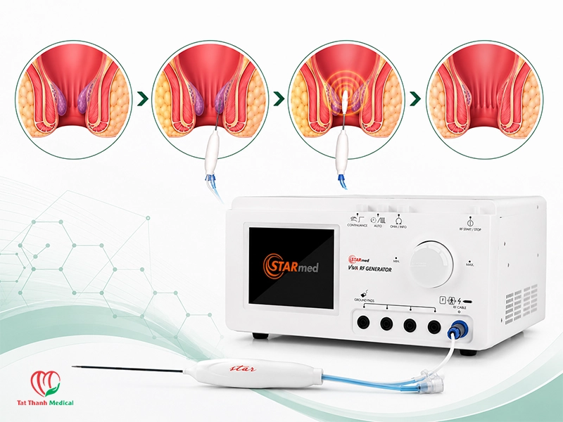 Điều trị trĩ bằng RFA là gì?