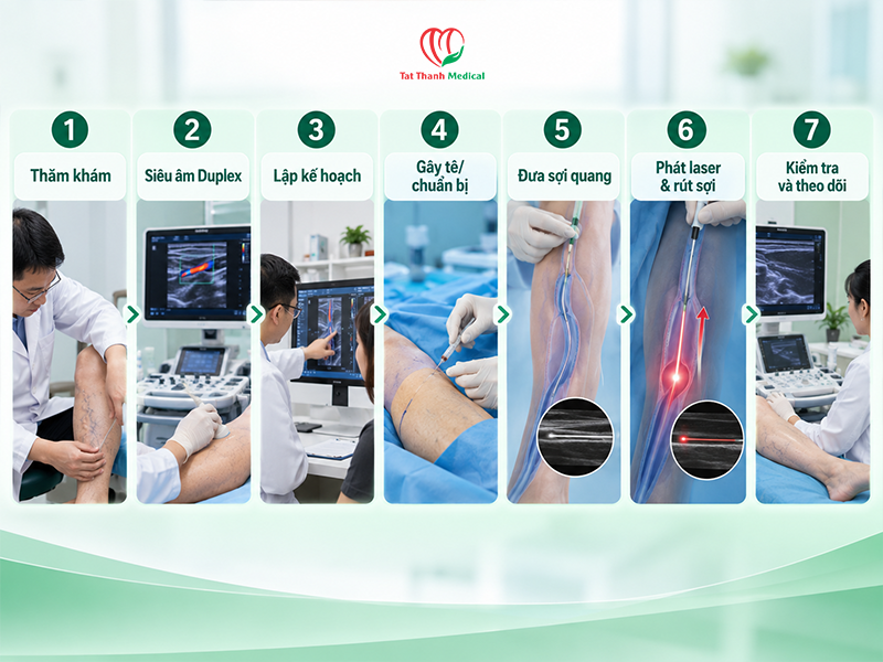 Quy trình điều trị suy giãn tĩnh mạch bằng Laser Harlas