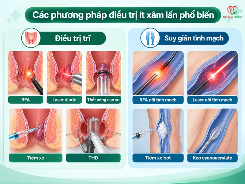 Các phương pháp phổ biến trong điều trị trĩ và suy giãn tĩnh mạch