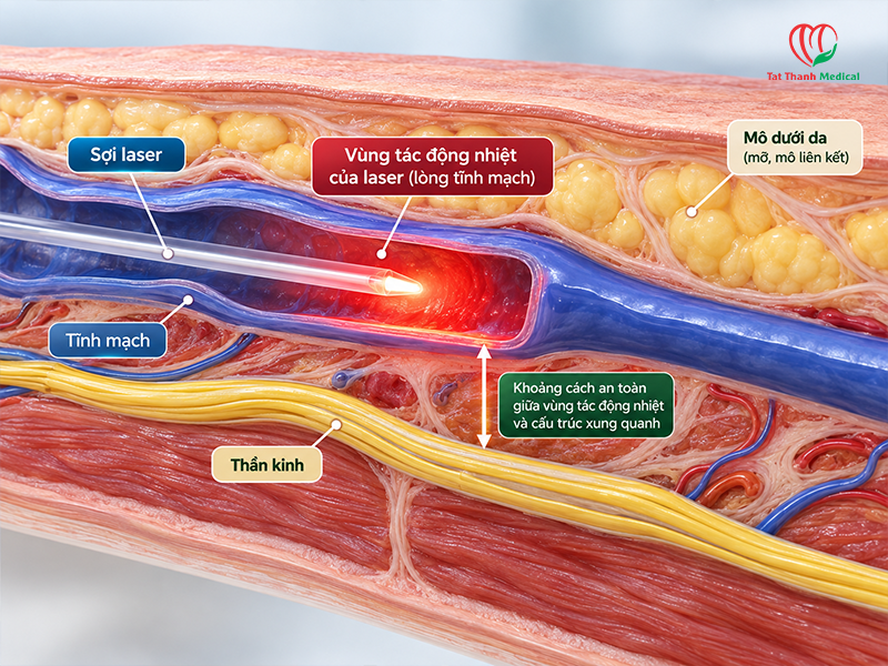 Những biến chứng có thể gặp khi điều trị suy giãn tĩnh mạch bằng laser Harlas