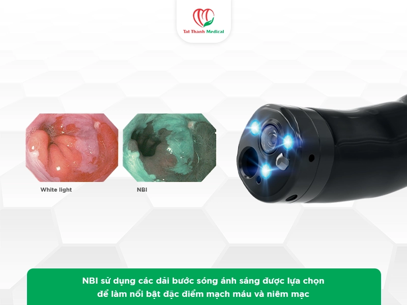 NBI là gì? Vì sao công nghệ này có ý nghĩa trong nội soi tiêu hóa?