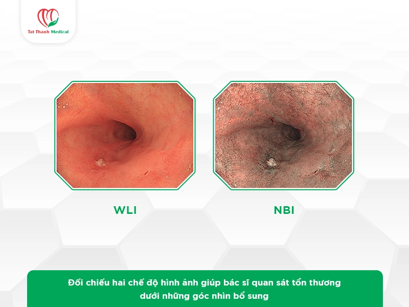 Quan sát và đánh giá tổn thương thực quản