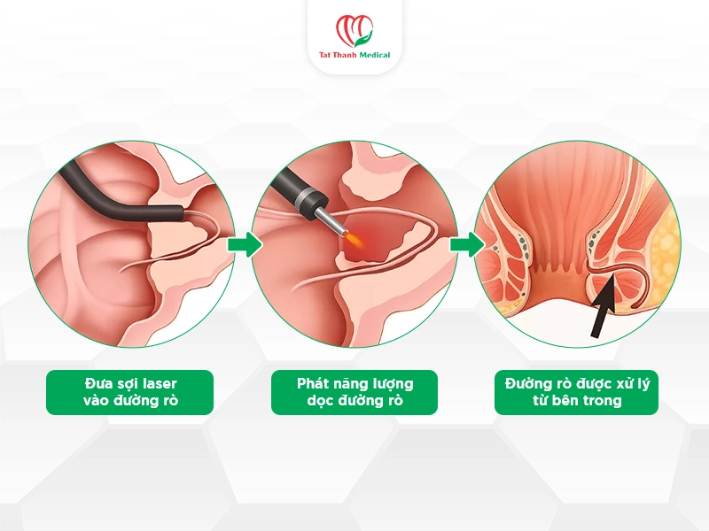 Laser đóng đường rò FiLaC là gì?