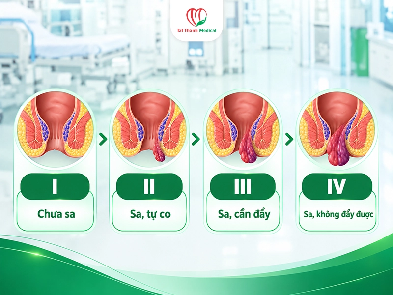 Vì sao cần sàng lọc ca bệnh trước điều trị trĩ ít xâm lấn?