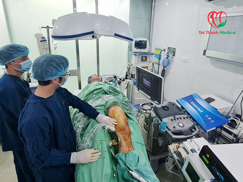 RFA điều trị giãn tĩnh mạch