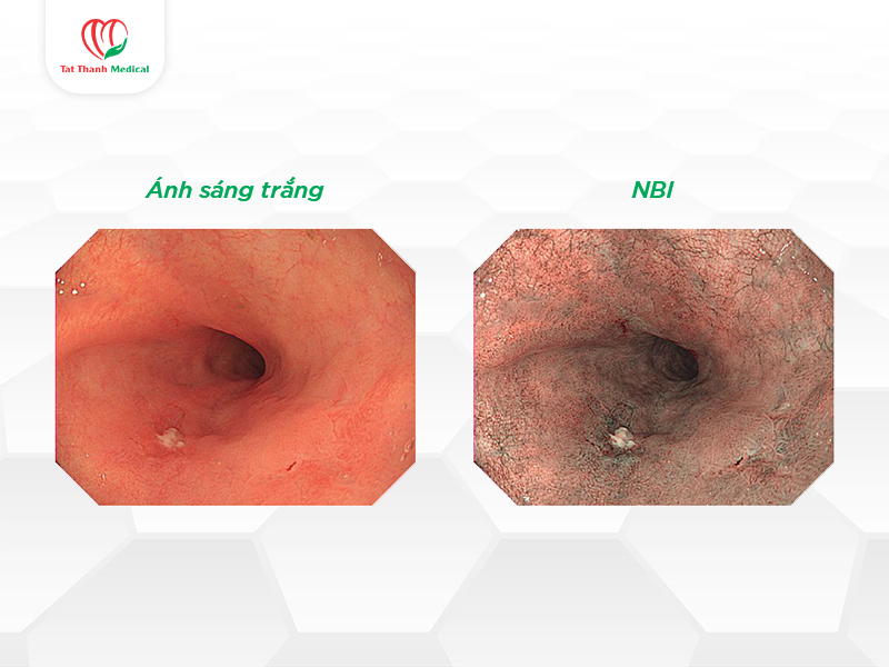 Công nghệ NBI