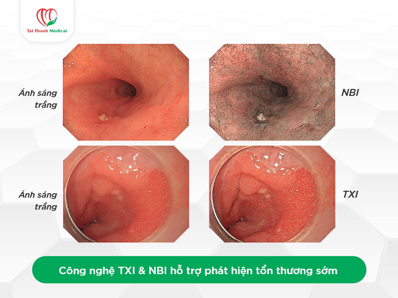 Ứng dụng NBI thế hệ mới