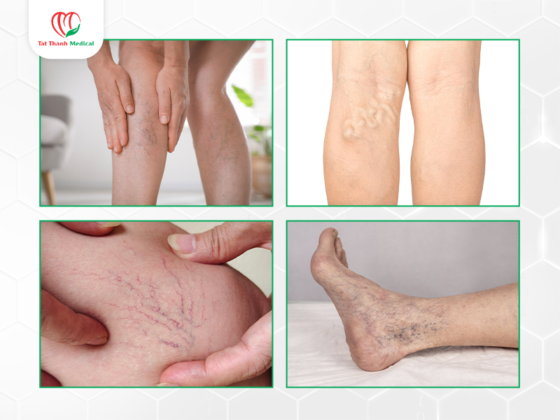 Suy giãn tĩnh mạch không chỉ là vấn đề thẩm mỹ