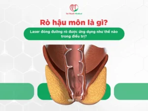 Rò hậu môn là gì? Laser đóng đường rò được ứng dụng như thế nào trong điều trị?