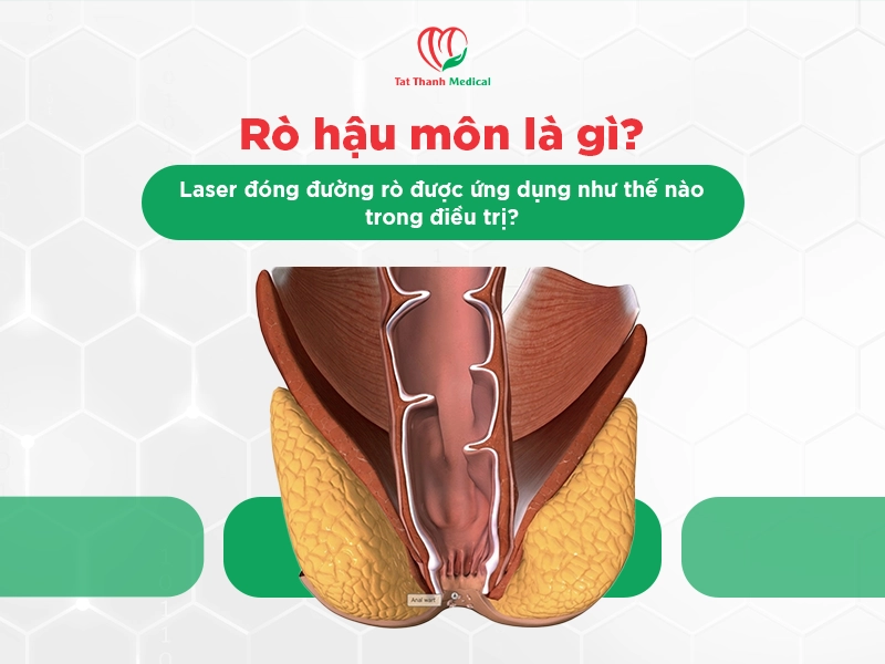 Rò hậu môn là gì? Laser đóng đường rò được ứng dụng như thế nào trong điều trị?